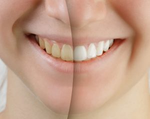 Teeth Whitening Charlottesville